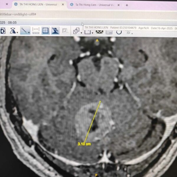 Brain tumor before treatment at European Wellness